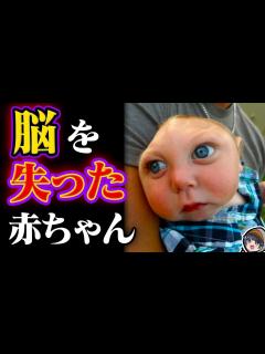 [x]脳がない状態で生まれた奇跡の子 - YouTube